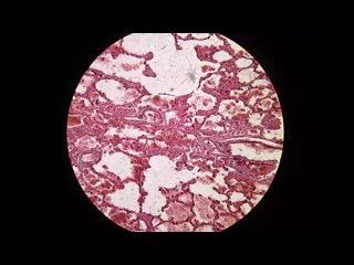 hemorrhagic infarction of the lung. pathoanatomy