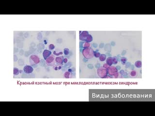 myelodysplastic syndrome. how to treat myelodysplastic syndrome.