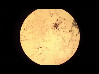 anthracosis of the lung. pathoanatomy