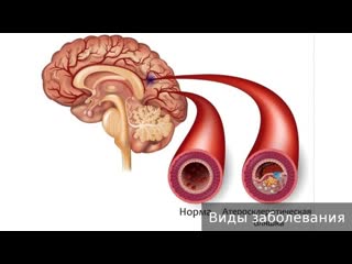 cerebral atherosclerosis. how to treat cerebral atherosclerosis.