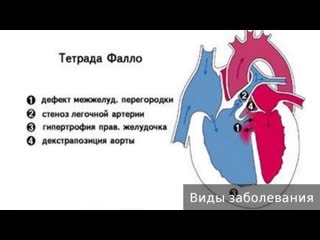 tetralogy of fallot. how to treat tetralogy of fallot.