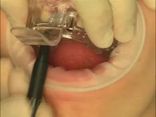 impression from the implant