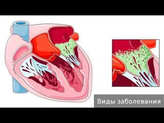 endocarditis. how to treat endocarditis.