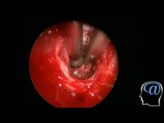 operation. craniotomy, removal of craniopharyngioma of the brain