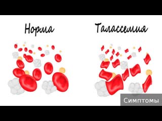 thalassemia. how to treat thalassemia.