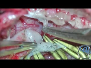 operation. the imposition of extraintracranial anastomosis (eicma) in cerebral ischemia.