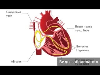 sinus node weakness syndrome. how to treat sinus node weakness syndrome.