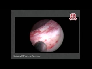 holmium laser enucleation of prostatic hyperplasia