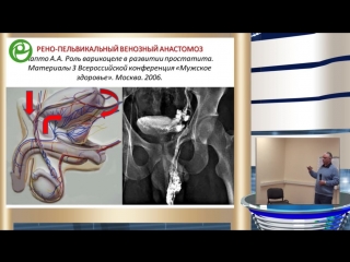 kapto a a. pelvic venous congestion in men.