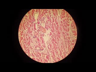 myocardial infarction. pathanatomy