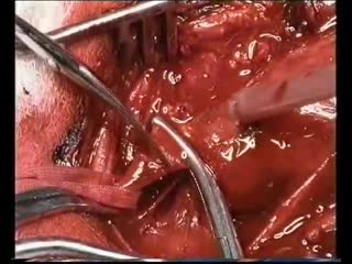 operation. removal of an aneurysm of the common carotid artery with plasty