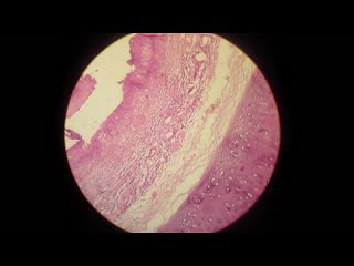 bronchitis. pathanatomy