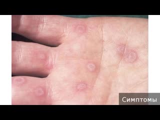 warts. how to treat warts.