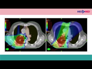 possibilities of proton therapy. clinical aspects