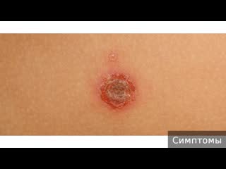 pyoderma. how to treat pyoderma.