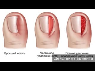 ingrown nail. how to treat an ingrown toenail.