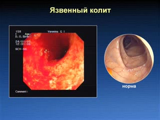 endoscopic diagnosis of nac