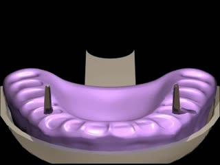 impression of the root canal of the tooth