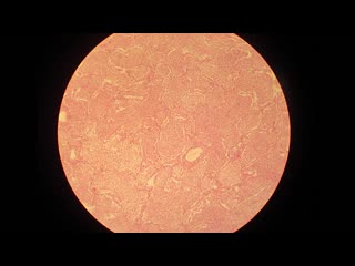 croupous pneumonia (photo). pathanatomy