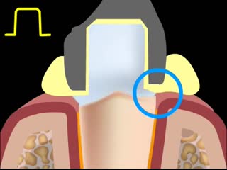 shoulder turning tooth