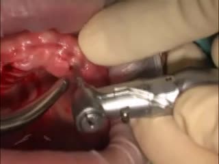 pilot drilling - dental implant