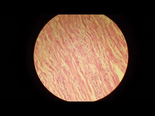 interstitial myocarditis. pathoanatomy