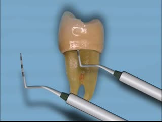 secondary caries