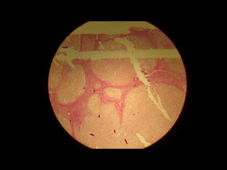 portal cirrhosis of the liver. pathoanatomy