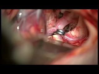 operation. clipping of an aneurysm of the internal carotid artery