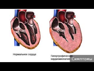 cardiomyopathy. how to treat cardiomyopathy.