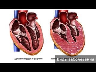 cardiomegaly. how to treat cardiomegaly.