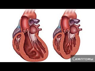 dilated cardiomyopathy. how to treat dilated cardiomyopathy.