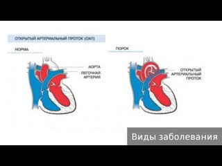 open ductus arteriosus. how to treat an open ductus arteriosus.