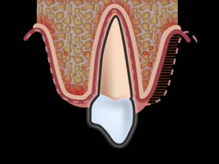 what is gum recession?