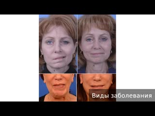 facial asymmetry. how to treat facial asymmetry.