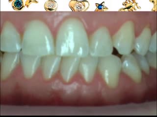 dental decoration