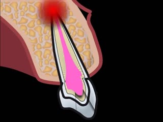 root apex resection