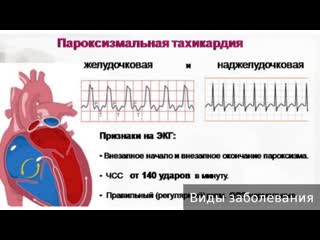 paroxysmal tachycardia. how to treat paroxysmal tachycardia.