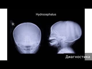 fetal hydrocephalus. how to treat fetal hydrocephalus.