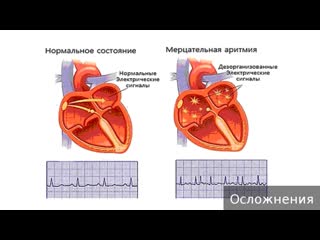 atrial fibrillation. how to treat atrial fibrillation.