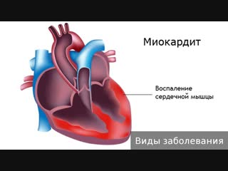 myocarditis. how to treat myocarditis.