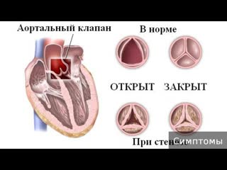 mitral stenosis. how to treat mitral stenosis.