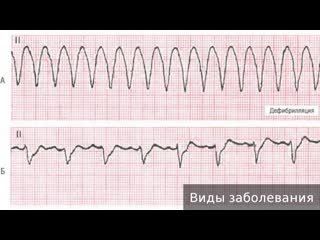 ventricular tachycardia. how to treat ventricular tachycardia.