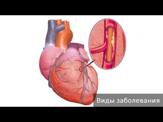 cardiac ischemia. how to treat coronary heart disease.