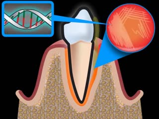 periodontitis