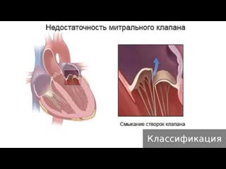 mitral valve insufficiency. how to treat mitral valve insufficiency.