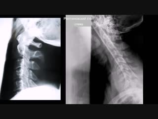 adequacy of the x-ray image of the cervical spine in lateral projection