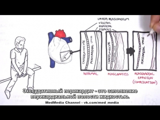 pericarditis - general overview