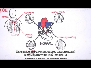 mitral regurgitation (regurgitation) - an overview