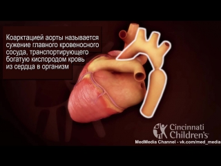 coarctation of the aorta - coarctation of the aorta